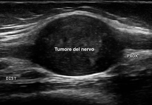 ecografia tumore del nervo